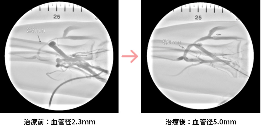 血管を広げた画像