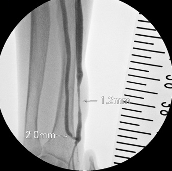 経皮的血管形成術(PTA)前後の血管造影画像